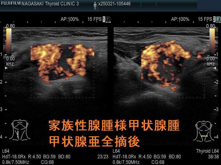 家族性腺腫様甲状腺腫(家族性多結節性甲状腺腫) 甲状腺亜全摘後 ドプラーモード 家族性腺腫様甲状腺腫(家族性多結節性甲状腺腫) 甲状腺亜全摘後 ドプラーモード
