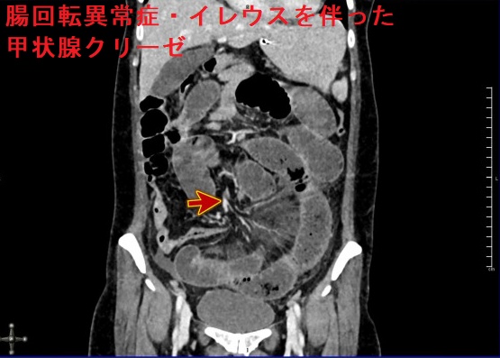腸回転異常症・イレウスを伴った甲状腺クリーゼ 腸回転異常症・イレウスを伴った甲状腺クリーゼ