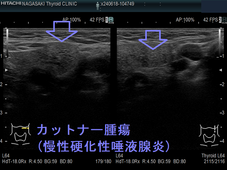 カットナー腫瘍(慢性硬化性唾液腺炎) カットナー腫瘍(慢性硬化性唾液腺炎)