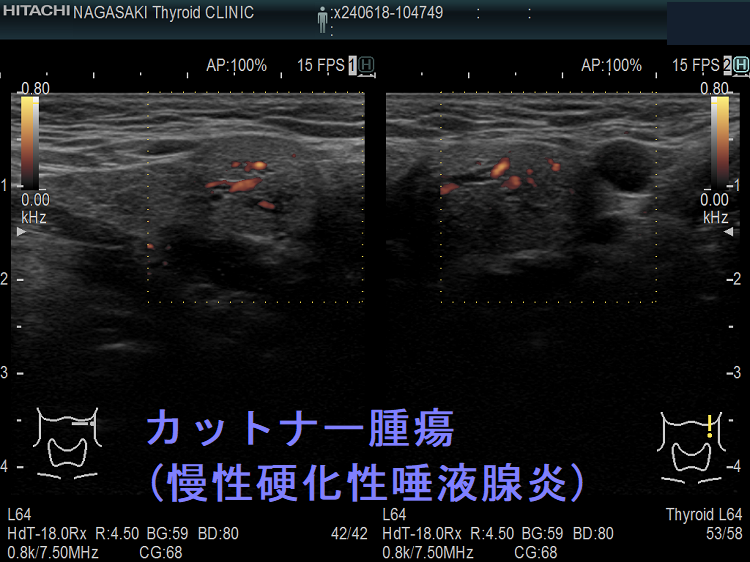 カットナー腫瘍(慢性硬化性唾液腺炎) ドプラーモード カットナー腫瘍(慢性硬化性唾液腺炎) ドプラーモード