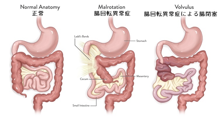 腸回転異常症 腸回転異常症