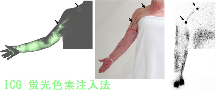 ICG(インドシアニングリーン) 蛍光色素注入法 ICG(インドシアニングリーン) 蛍光色素注入法