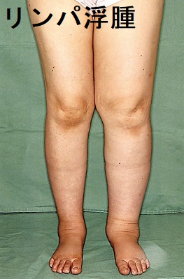 リンパ浮腫 リンパ浮腫2