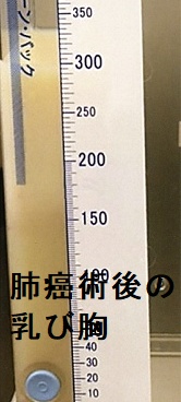 肺癌術後の乳び胸 肺癌術後の乳び胸