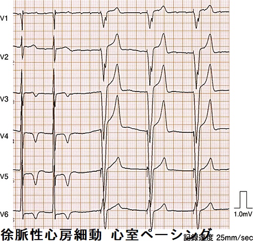 徐脈性心房細動 心室ペーシングの恒久的ペースメーカー 徐脈性心房細動 心室ペーシングの恒久的ペースメーカー