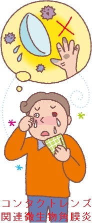 コンタクトレンズ関連微生物角膜炎 コンタクトレンズ関連微生物角膜炎
