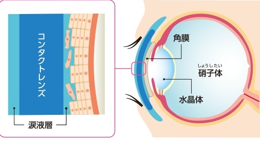 コンタクトレンズ関連微生物角膜炎2 コンタクトレンズ関連微生物角膜炎2
