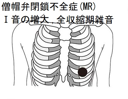 僧帽弁閉鎖不全症(MR) Ⅰ音の増大 僧帽弁閉鎖不全症(MR) Ⅰ音の増大