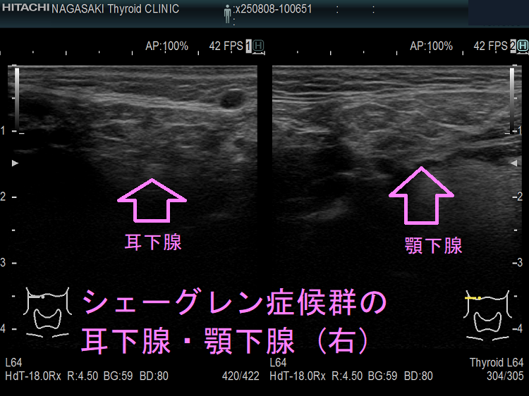 シェーグレン症候群の耳下腺・顎下腺 (右) 超音波(エコー)画像 シェーグレン症候群の耳下腺・顎下腺 (右)