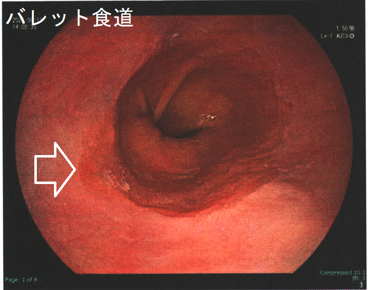 バレット食道 内視鏡像 バレット食道
