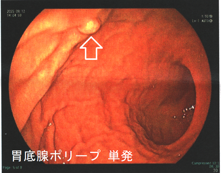 胃底腺ポリープ 単発 胃底腺ポリープ 単発
