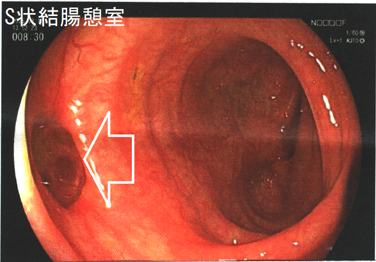 S状結腸憩室 S状結腸憩室