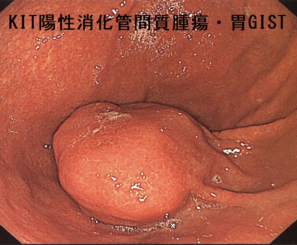 KIT陽性消化管間質腫瘍・胃GIST 内視鏡像 KIT陽性消化管間質腫瘍・胃GIST 内視鏡像