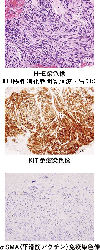KIT陽性消化管間質腫瘍・胃GIST 組織像 KIT陽性消化管間質腫瘍・胃GIST 組織像