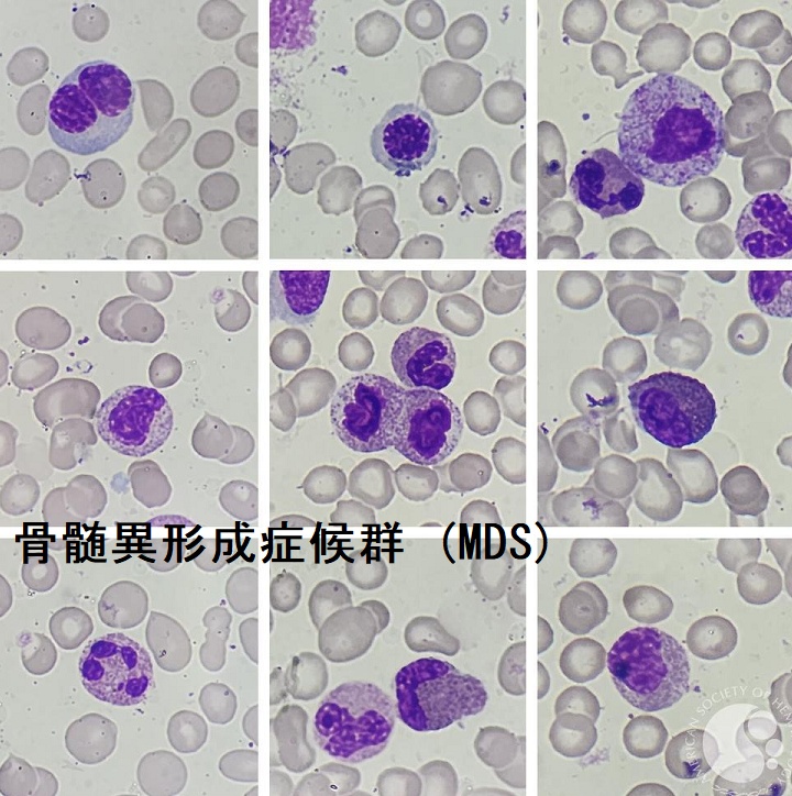 骨髄異形成症候群 (MDS) 骨髄異形成症候群 (MDS)
