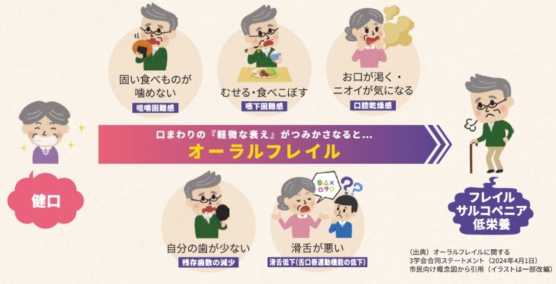 フレイル(虚弱)・オーラルフレイルと甲状腺 フレイル(虚弱)・オーラルフレイルと甲状腺