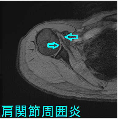 肩関節周囲炎 MRI T2画像 肩関節周囲炎 MRI T2画像