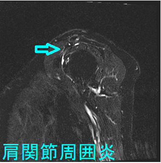 肩関節周囲炎 T2強調脂肪抑制画像 肩関節周囲炎 T2強調脂肪抑制画像