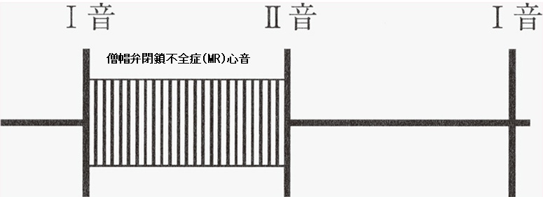 僧帽弁閉鎖不全症(MR)心音 僧帽弁閉鎖不全症(MR)心音