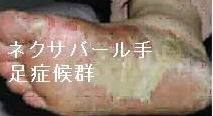 ネクサバール(ソラフェニブ)の副作用 手足症候群 ネクサバール(ソラフェニブ)の副作用 手足症候群