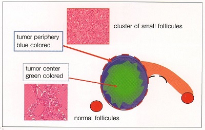 広範浸潤型濾胞癌至適穿刺部位