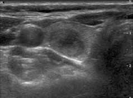 甲状腺髄様癌　超音波(エコー)画像