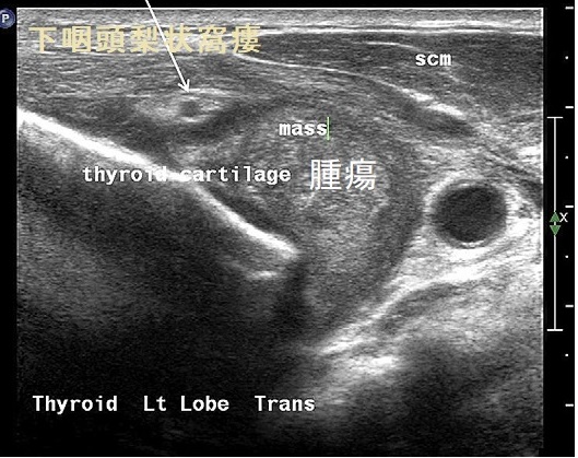下咽頭梨状窩瘻 超音波(エコー)画像