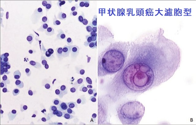 甲状腺乳頭癌大濾胞型の細胞診