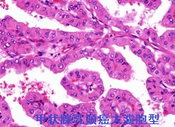 甲状腺乳頭癌大濾胞型 組織診
