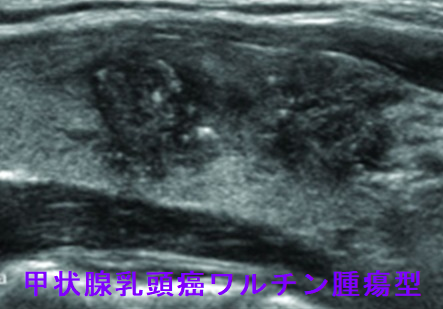 甲状腺乳頭癌ワルチン腫瘍型 超音波（エコー）画像