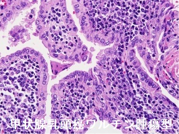 甲状腺乳頭癌ワルチン腫瘍型 組織診