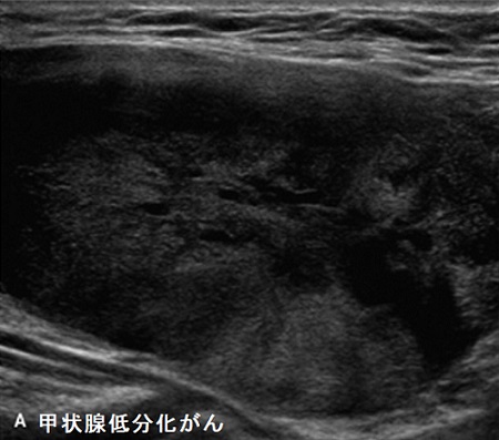 甲状腺低分化がん　超音波(エコー)画像