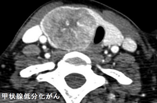 甲状腺低分化がん CT画像