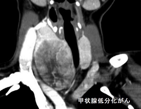 甲状腺低分化がん CT画像