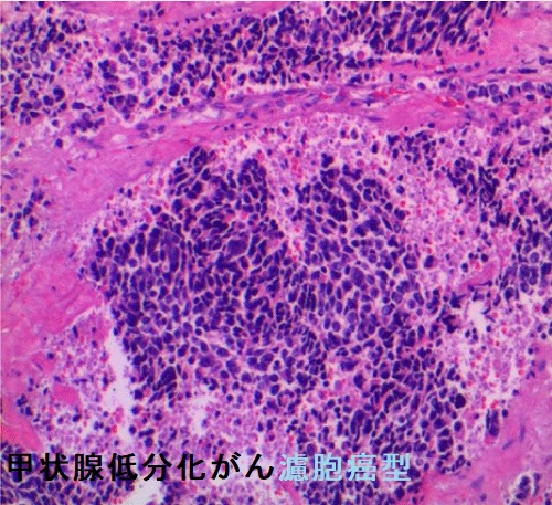 甲状腺低分化癌濾胞癌型 組織診