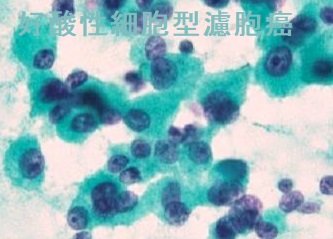 甲状腺濾胞癌(好酸性細胞型)細胞診