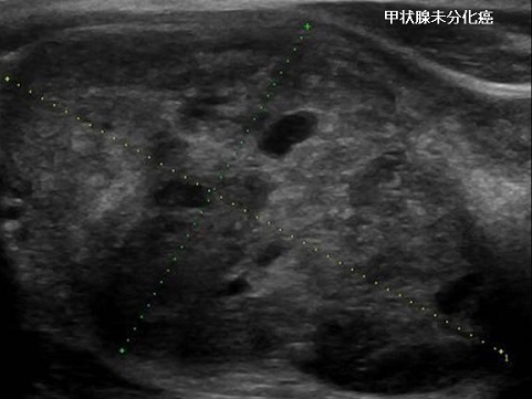 甲状腺未分化癌 甲状腺専門医 橋本病 バセドウ病 甲状腺超音波エコー検査 長崎甲状腺クリニック大阪