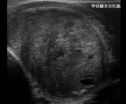 甲状腺未分化癌 超音波(エコー)画像