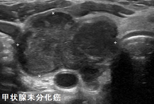 甲状腺未分化癌　超音波(エコー)画像