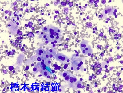 橋本病結節 好酸性細胞・リンパ球浸潤