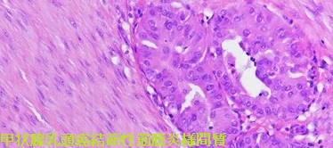 甲状腺乳頭癌結節性筋膜炎様間質(PTC-FS) 組織（拡大）