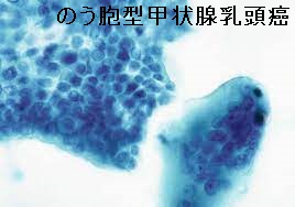 のう胞型甲状腺乳頭癌 細胞診