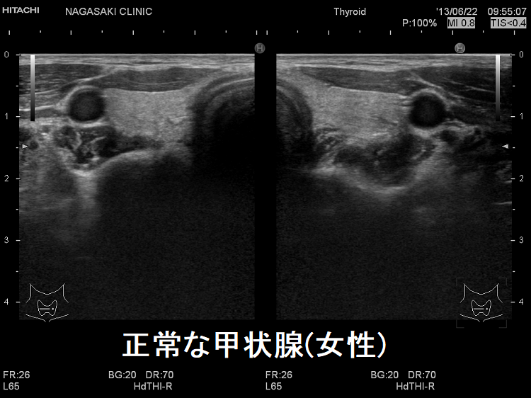 正常な甲状腺 超音波(エコー)画像