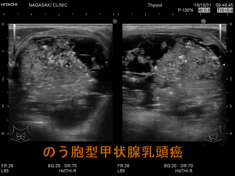のう胞型甲状腺乳頭癌 超音波(エコー)画像