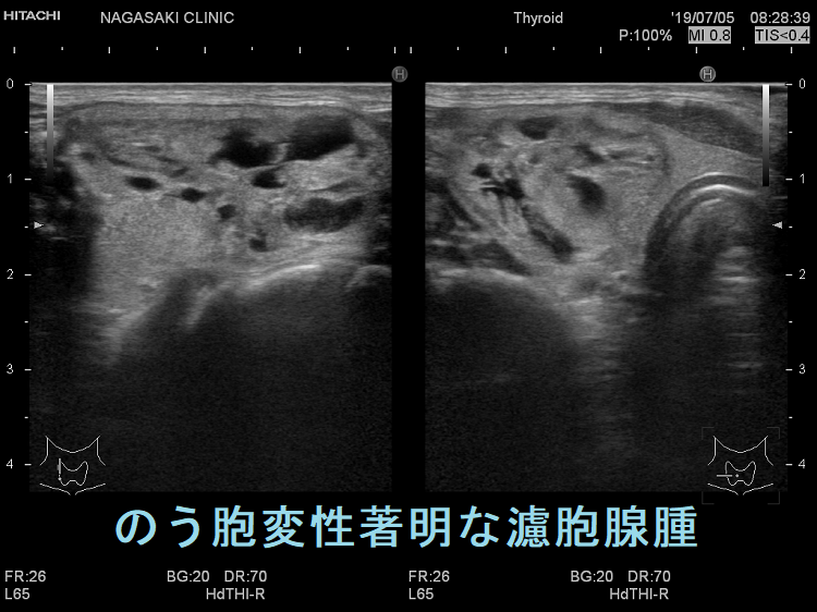のう胞変性著明な濾胞腺腫 超音波(エコー)画像