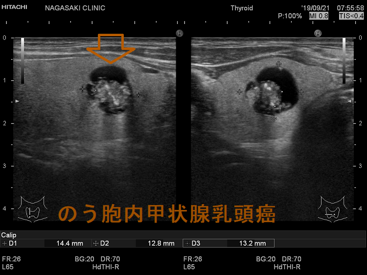 のう胞内甲状腺乳頭癌 超音波(エコー)画像