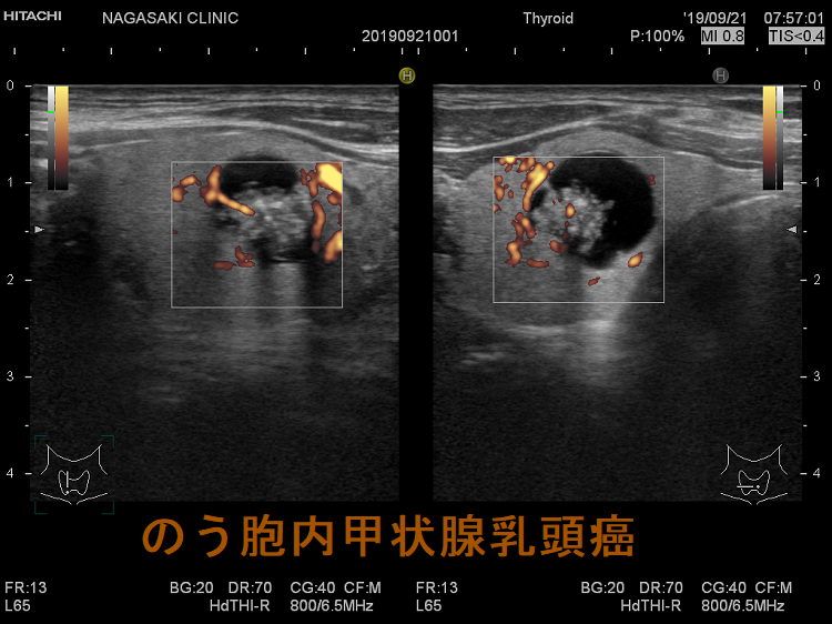 のう胞内甲状腺乳頭癌 超音波(エコー)画像 ドプラー