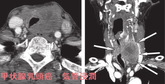 甲状腺乳頭癌　気管浸潤　CT画像