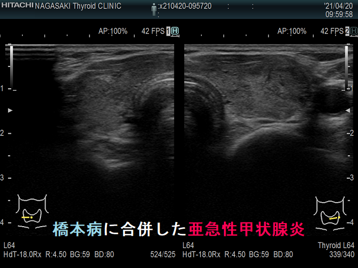 橋本病に合併した亜急性甲状腺炎 2カ月後 超音波(エコー)画像1
