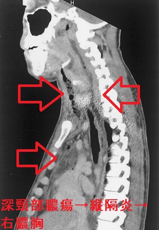 深頸部膿瘍、縦隔炎、右膿胸 CT画像